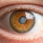 Cirurgia de catarata melhora sono e saúde, diz pesquisa