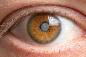 Cirurgia de catarata melhora sono e saúde, diz pesquisa